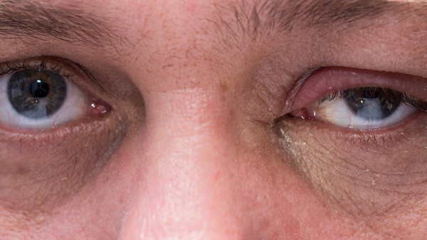 眼结石的预防措施有什么 戴隐形会引发眼界是吗