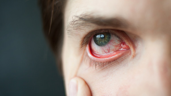 眼结石症状有哪些，你不能忽视的眼部健康