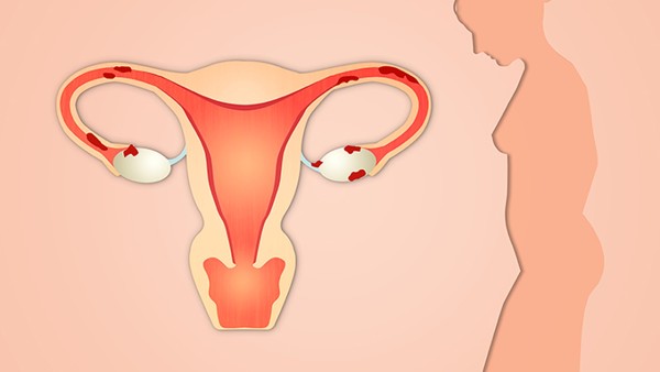 子宫肌瘤的五大原因是什么 子宫肌瘤怎样形成原因