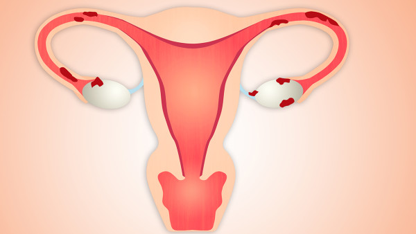 什么是子宫肌瘤和子宫囊肿 子宫肌瘤和囊肿什么区别