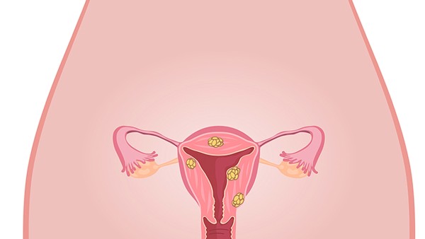 子宫肌瘤与什么变化有关 子宫肌瘤发生可能与哪项因素有关