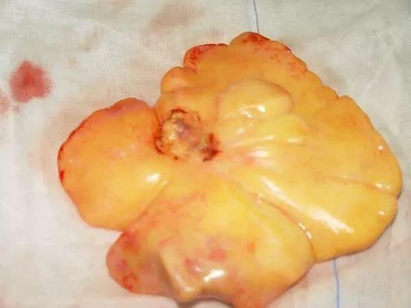 脂肪瘤鉴别诊断