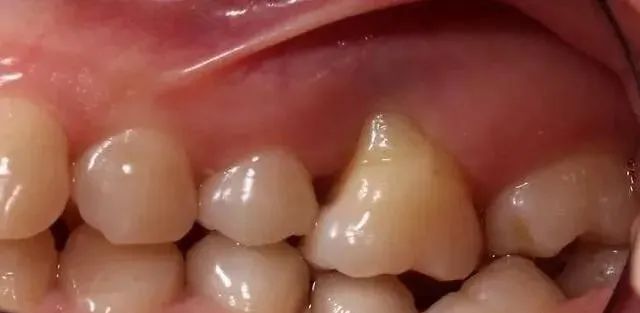 牙龈萎缩能治吗
