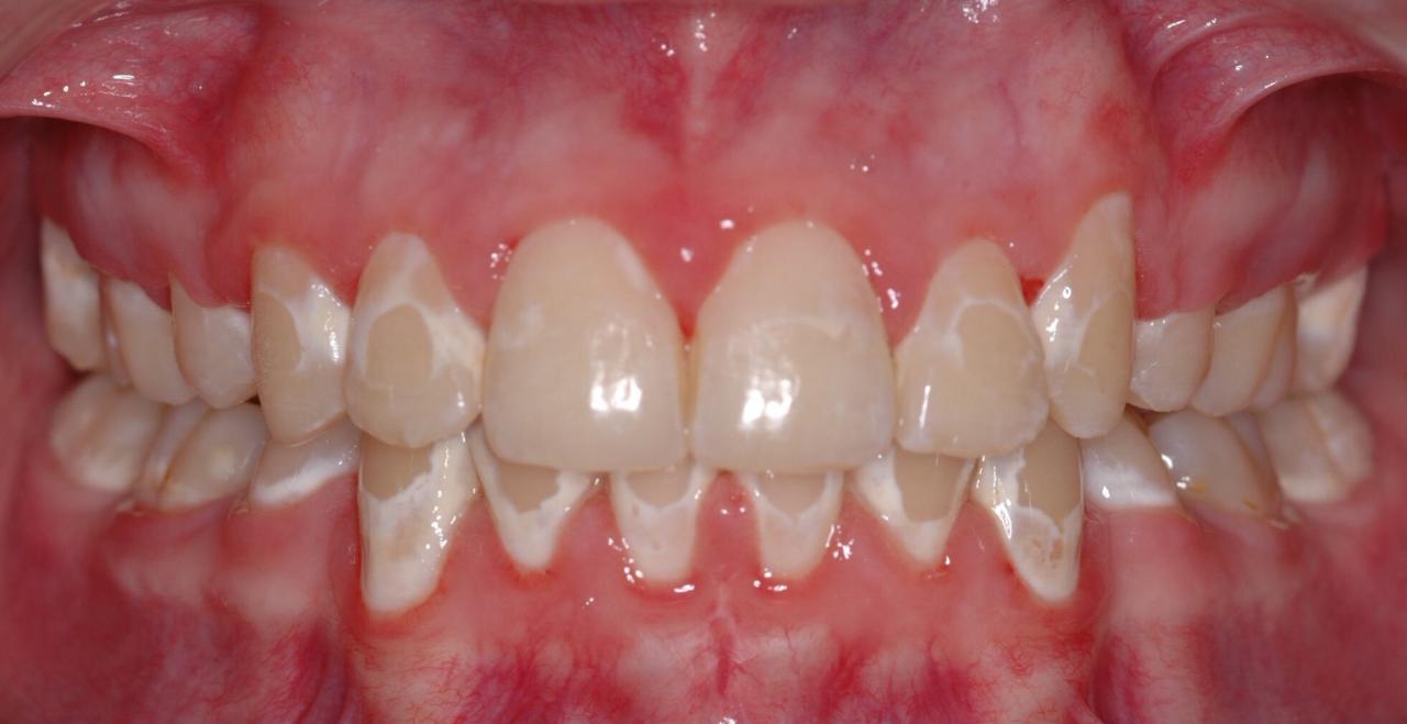 牙龈萎缩是什么原因造成的
