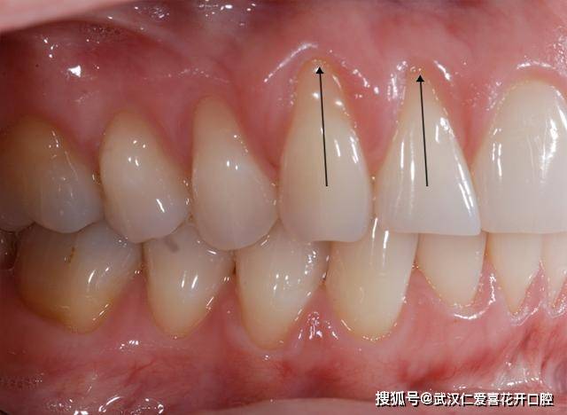 牙龈萎缩是什么原因造成的