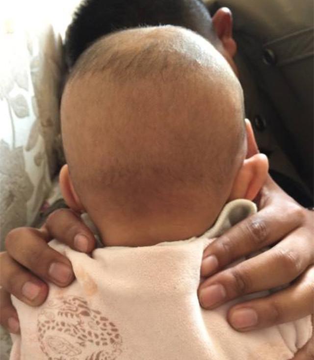 婴儿掉头发正常吗