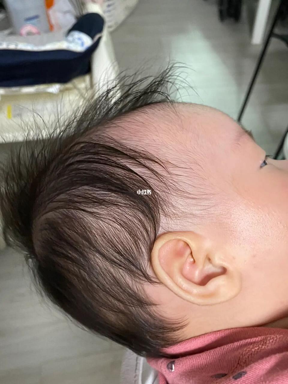 婴儿掉头发正常吗