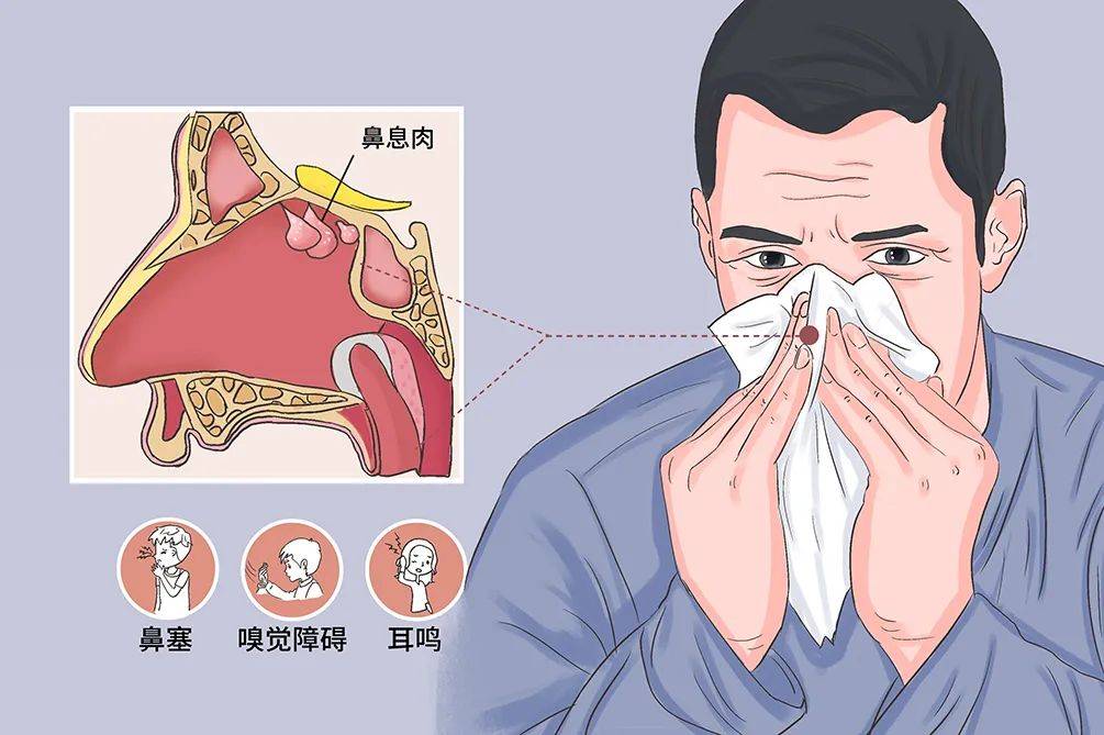 鼻咽炎症状有哪些