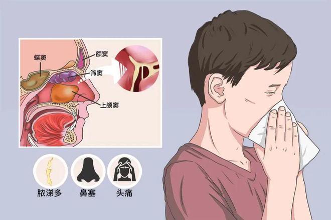 鼻咽炎症状有哪些