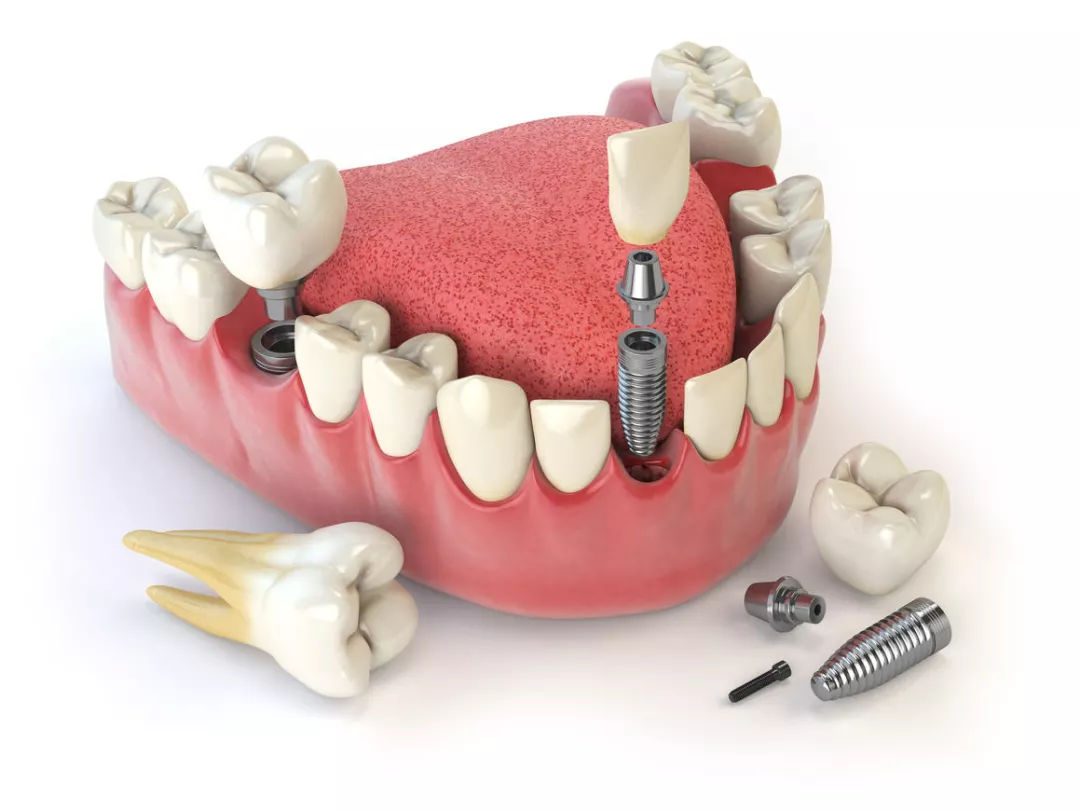 镶牙和种牙的区别