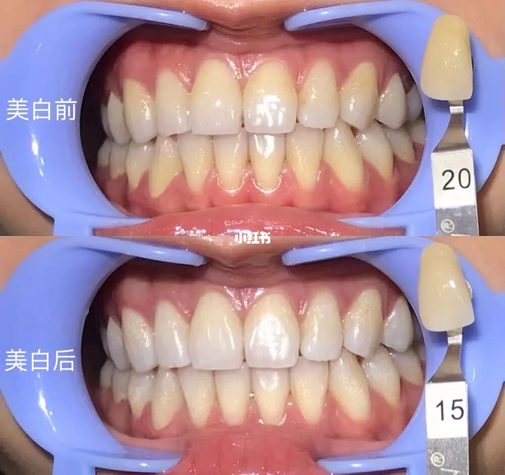 黄牙怎么变白的简单方法