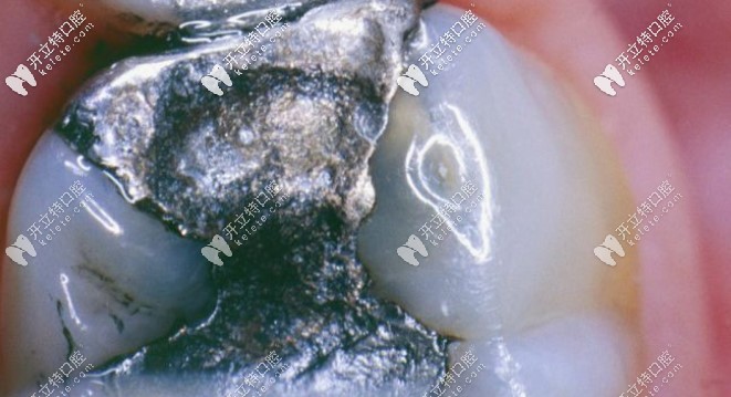 银汞合金补牙有害吗