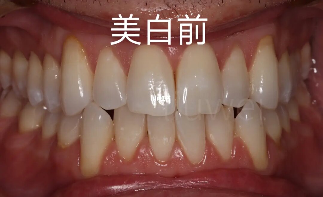 黄牙怎么变白的简单方法