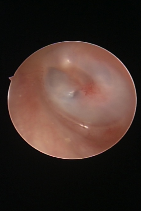 耳膜穿孔手术