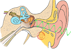 耳膜穿孔手术