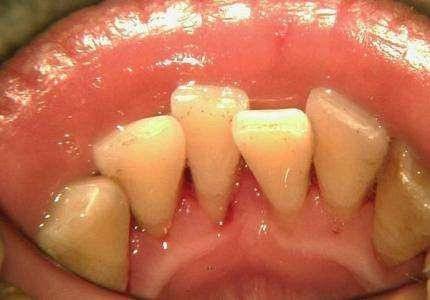 牙龈萎缩能治好吗