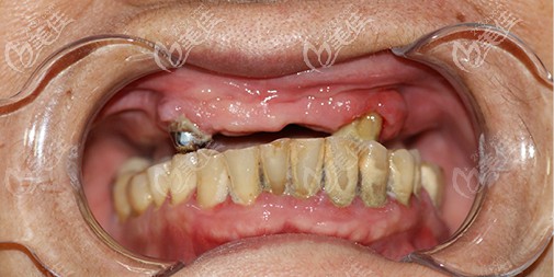 牙龈萎缩能治好吗