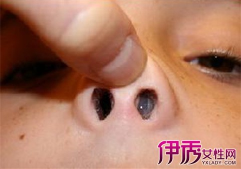 隆鼻感染初期症状