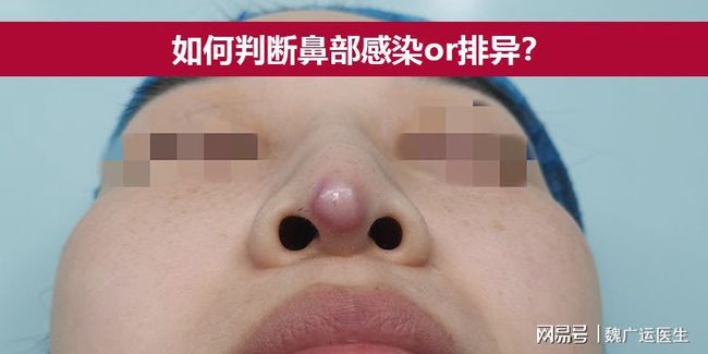 隆鼻感染初期症状