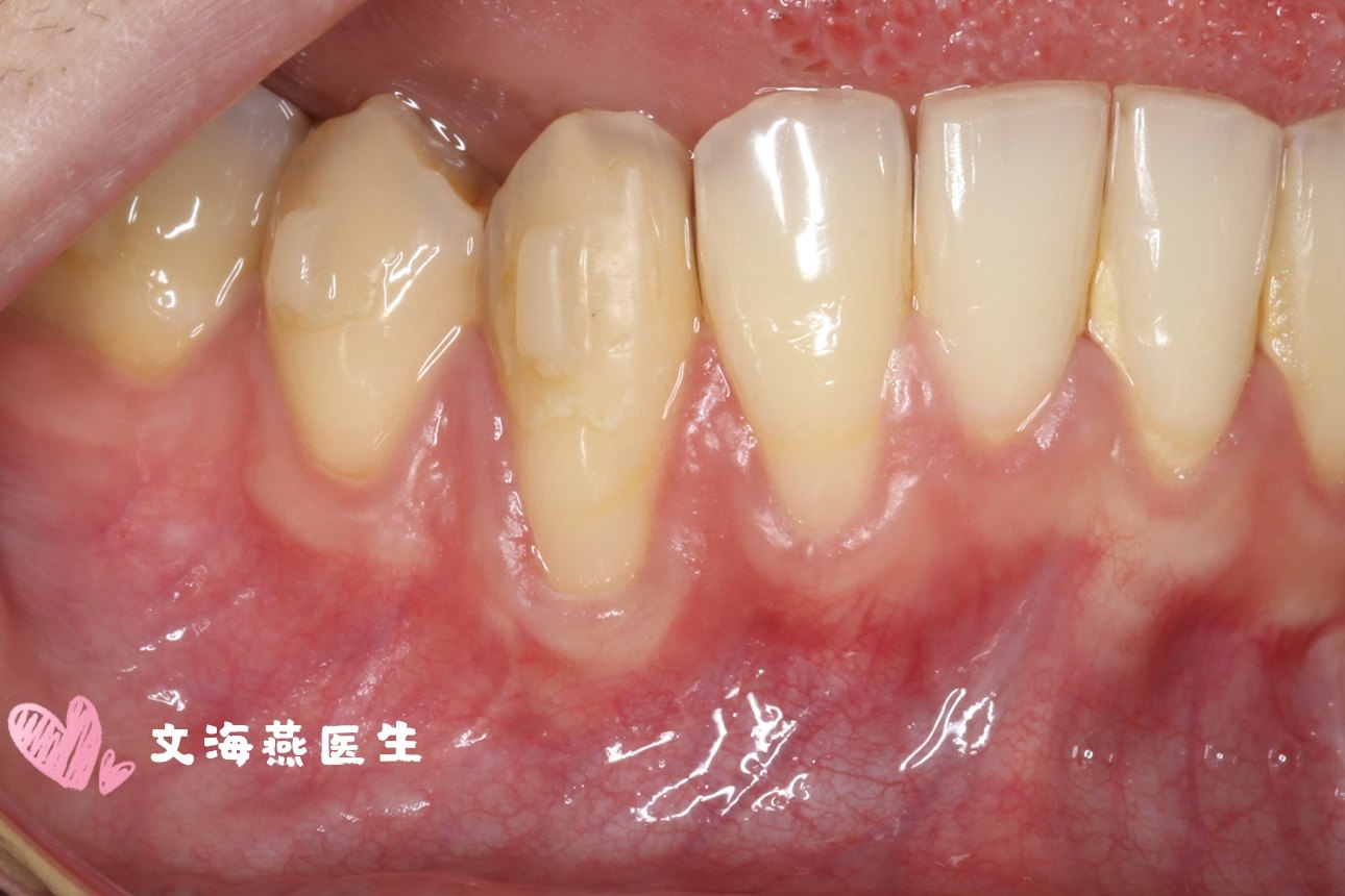牙龈萎缩的原因和治疗方法