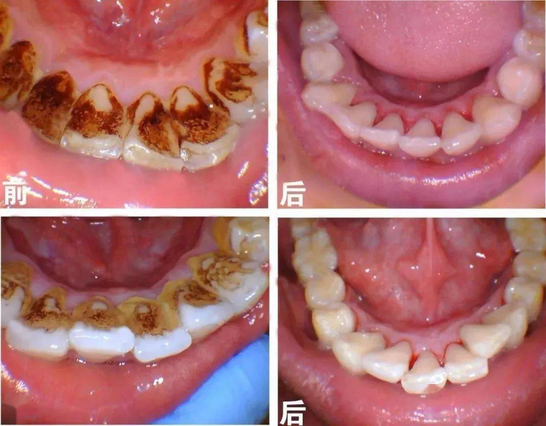 牙龈萎缩的原因和治疗方法