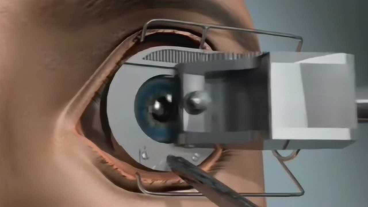 远视眼手术多少钱