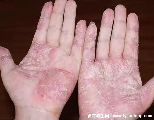 汗疱疹是什么原因引起