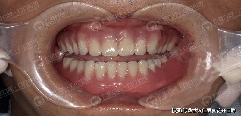 牙龈萎缩是什么病