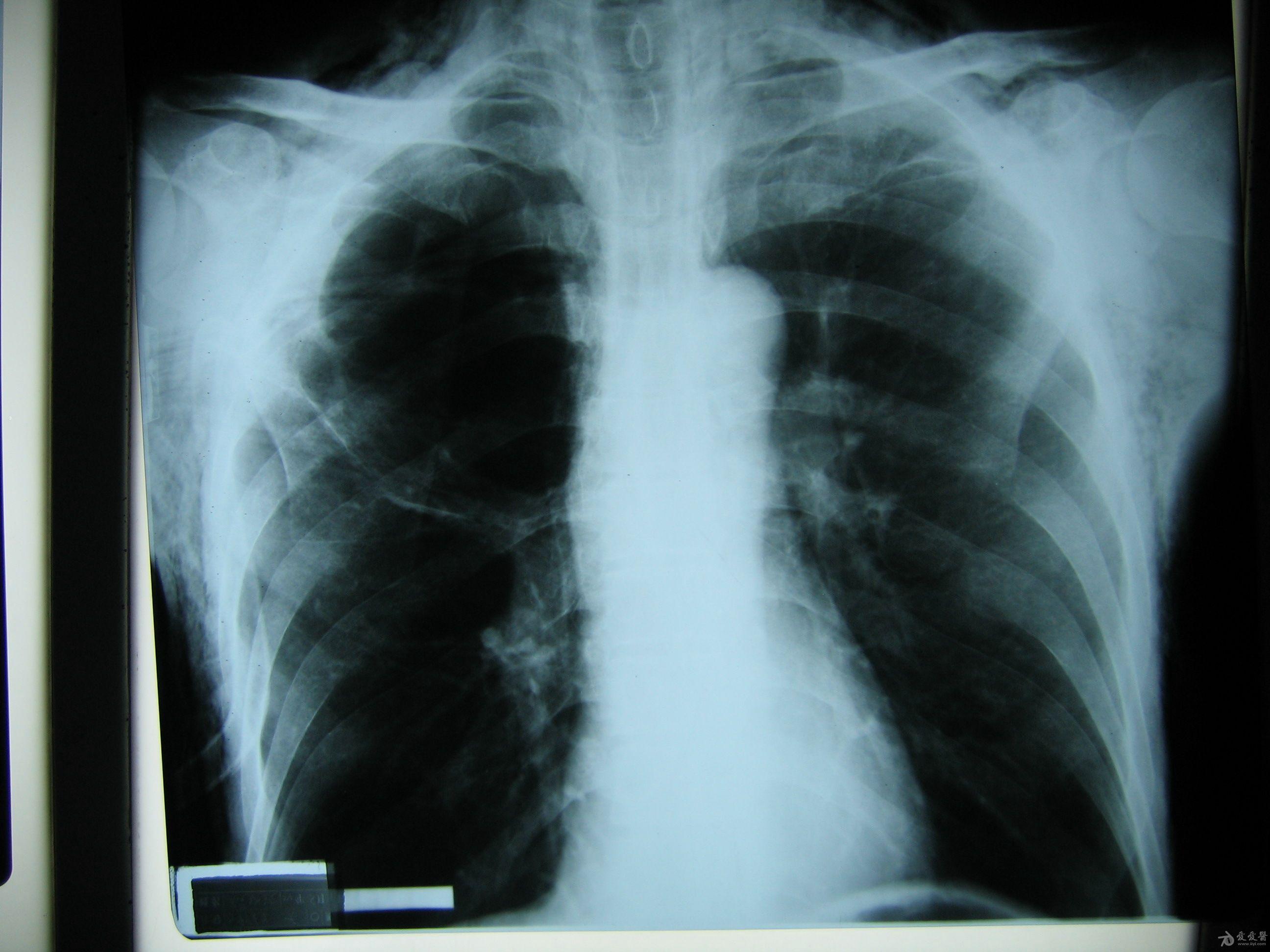 肺大疱是什么病