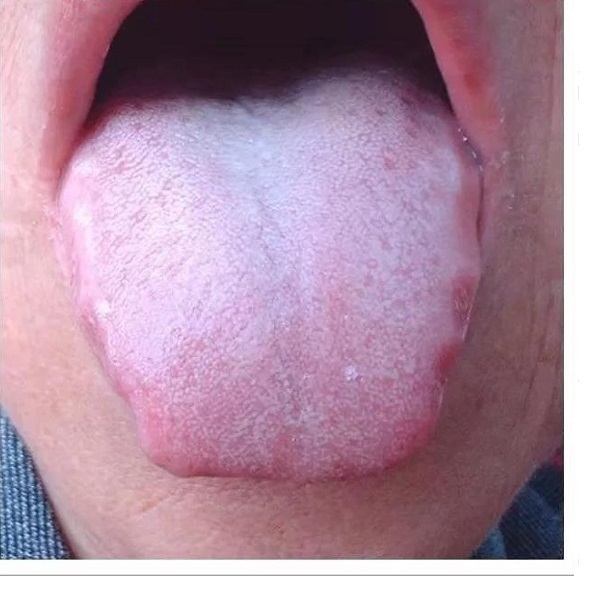 舌苔发黑是怎么回事
