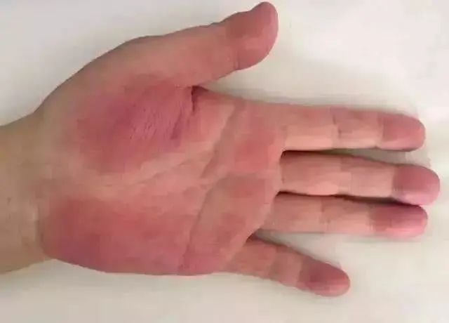 手掌发红是肝病吗