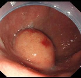 胃窦的位置图片