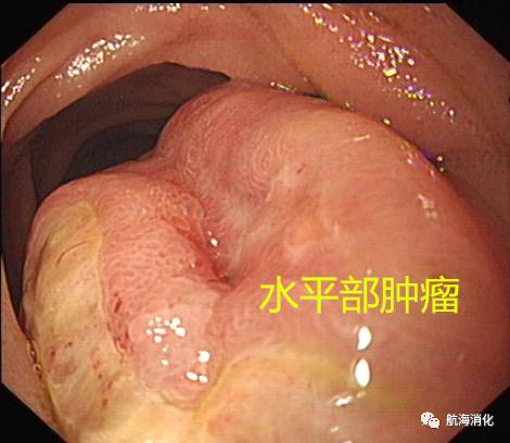 胃窦的位置图片