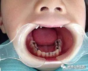 经期可以补牙吗