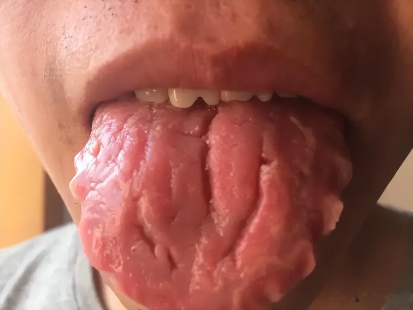 舌头黄苔是怎么回事