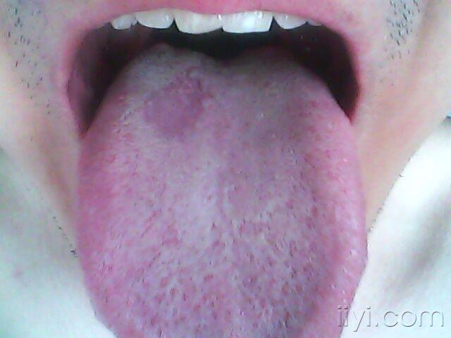 舌头黄苔是怎么回事