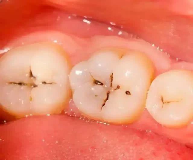乳牙是什么