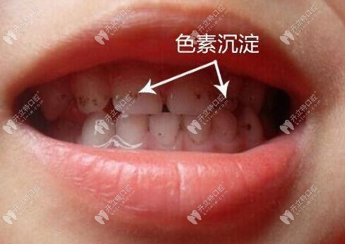 四环素牙怎样才能变白