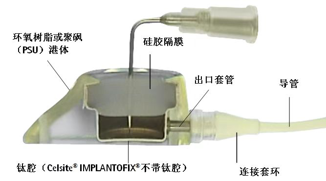 静脉输液港